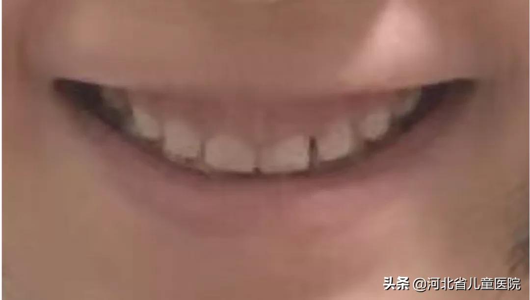 前牙龋坏修复好的案例,牙面龋坏修复全过程