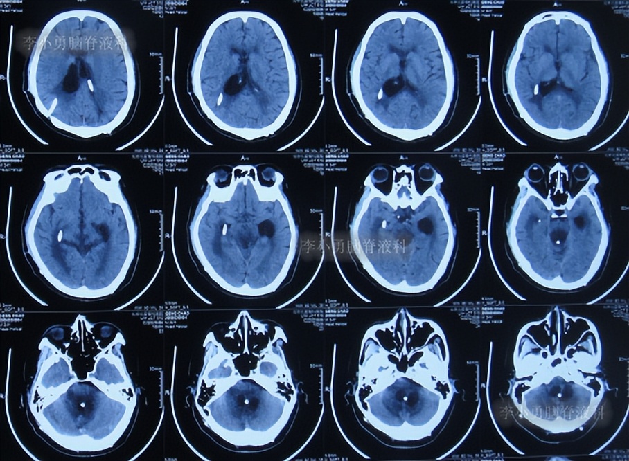 脑积水三脑室造瘘多久能恢复,脑囊虫手术后脑积水