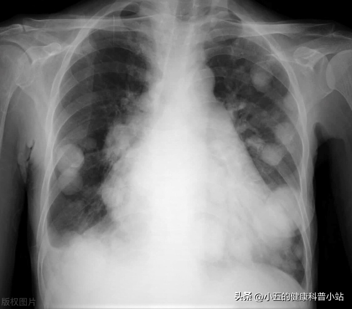 盐酸氨溴索口服溶液治疗肺炎,支气管肺炎用盐酸氨溴索效果好吗