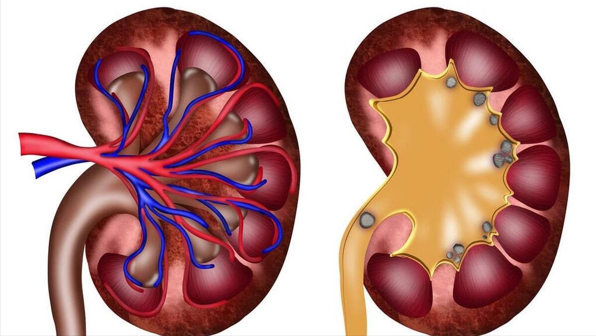 什么原因会导致输尿管狭窄,输尿管狭窄导致什么后果