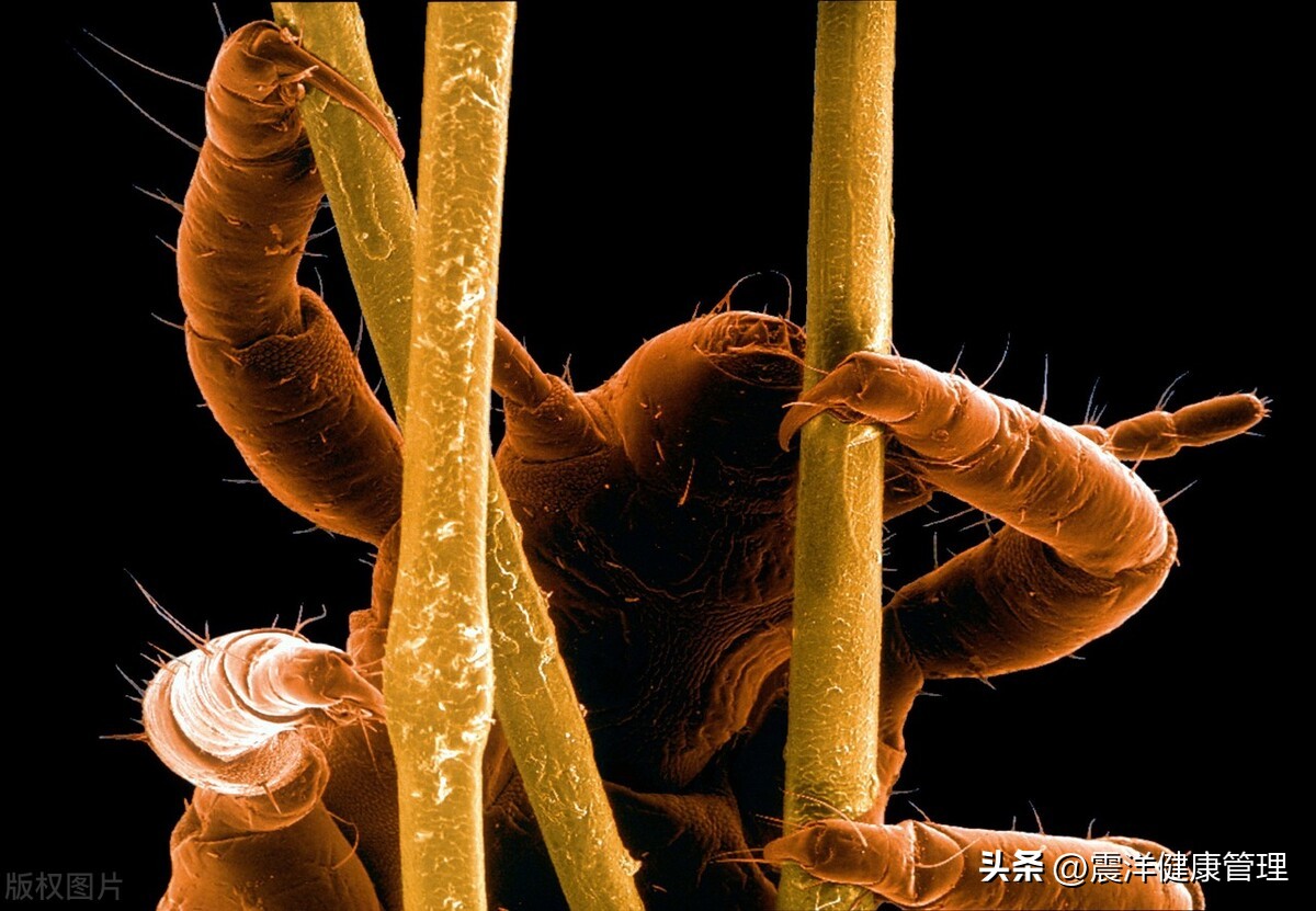 阴虱是什么？为什么有人“莫名其妙”染上了？3个传播途径要知道