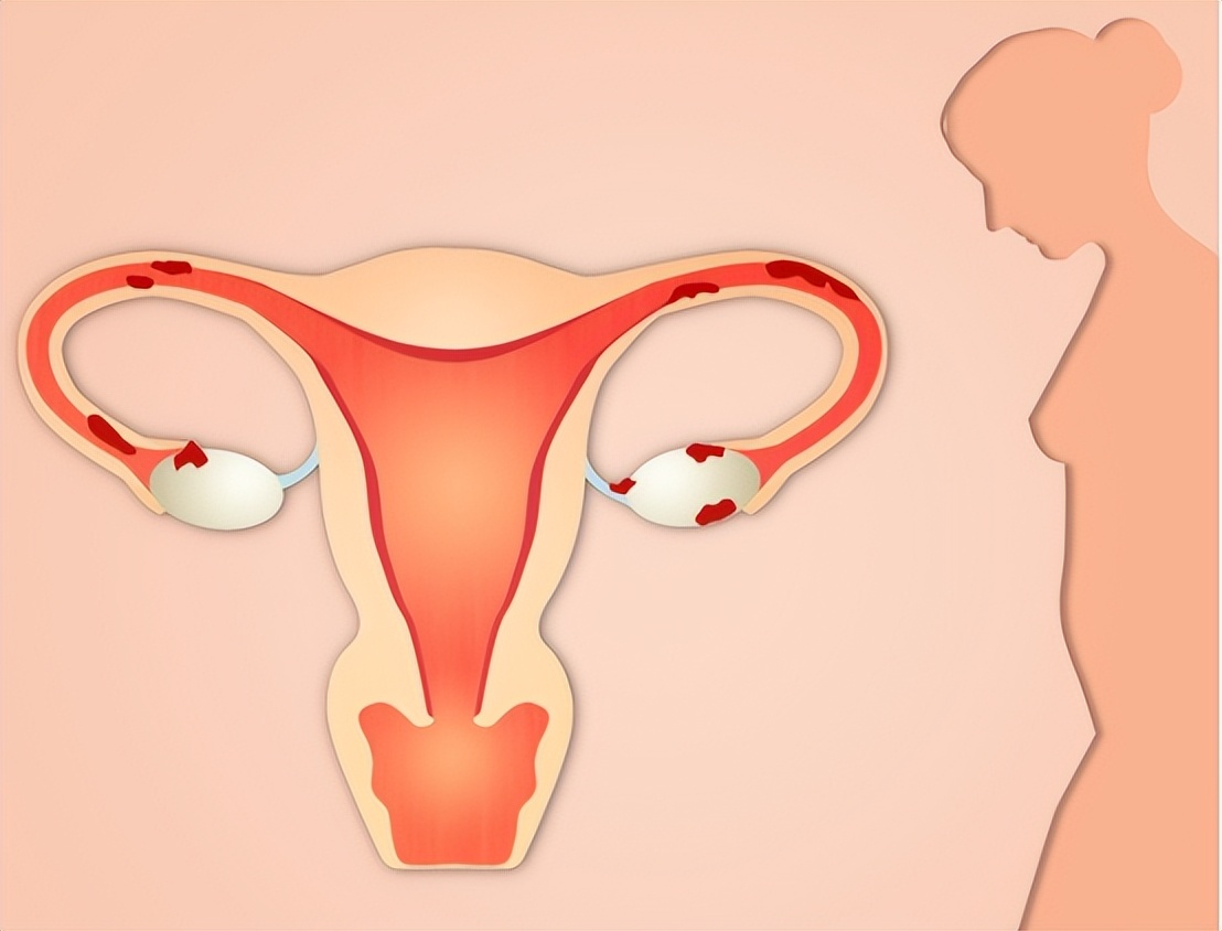 尿路感染自救方法,尿路感染怎样长期抑菌治疗