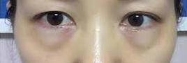 眼袋和卧蚕修复,眼袋大很显老一招眼袋变卧蚕