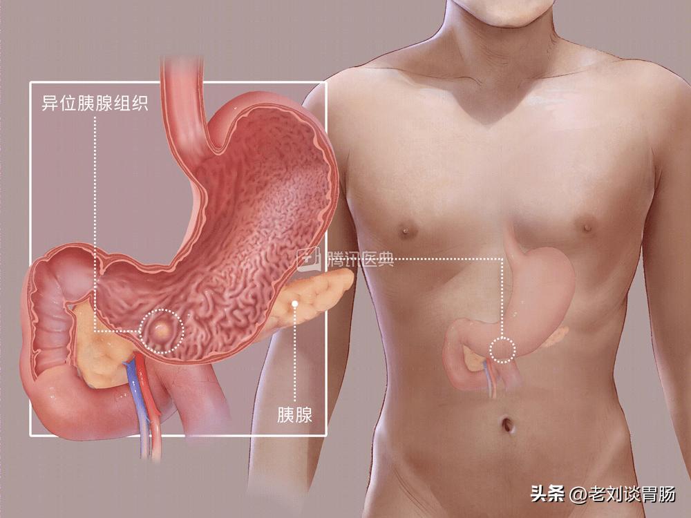 什么是异位灶怎么治疗,异位胰腺是怎么引起的