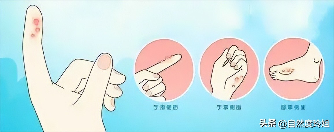 夏天手脚起小水泡严重脱皮,手脚长痒痒的小水泡