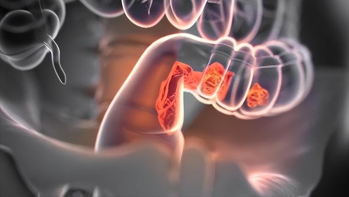 什么情况下医生才建议做肠镜,做过无痛肠镜后身体有什么症状