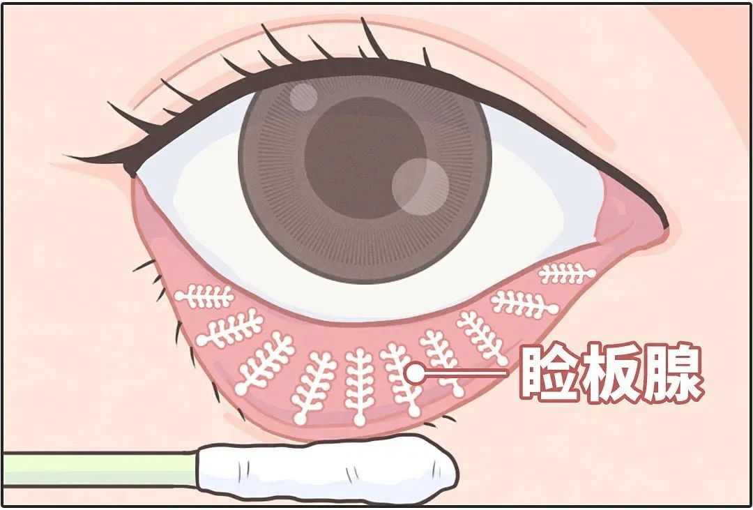 眼干涩，眼疲劳，怎么办？两个小办法帮你缓解