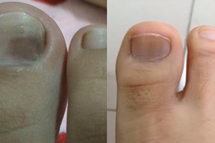 指甲亮白修护液,指甲生长期用什么抑菌液