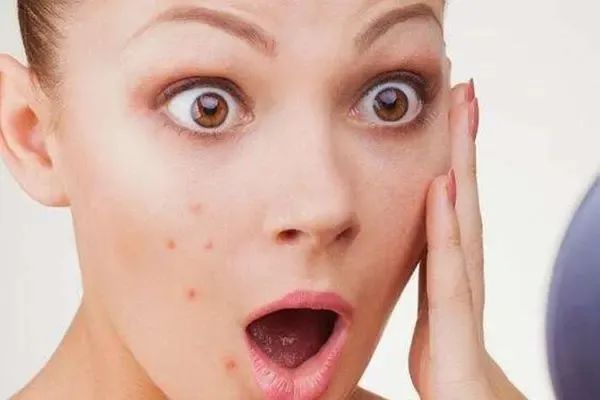 起痘长痘消痘的过程,脸上爆痘千万不要急