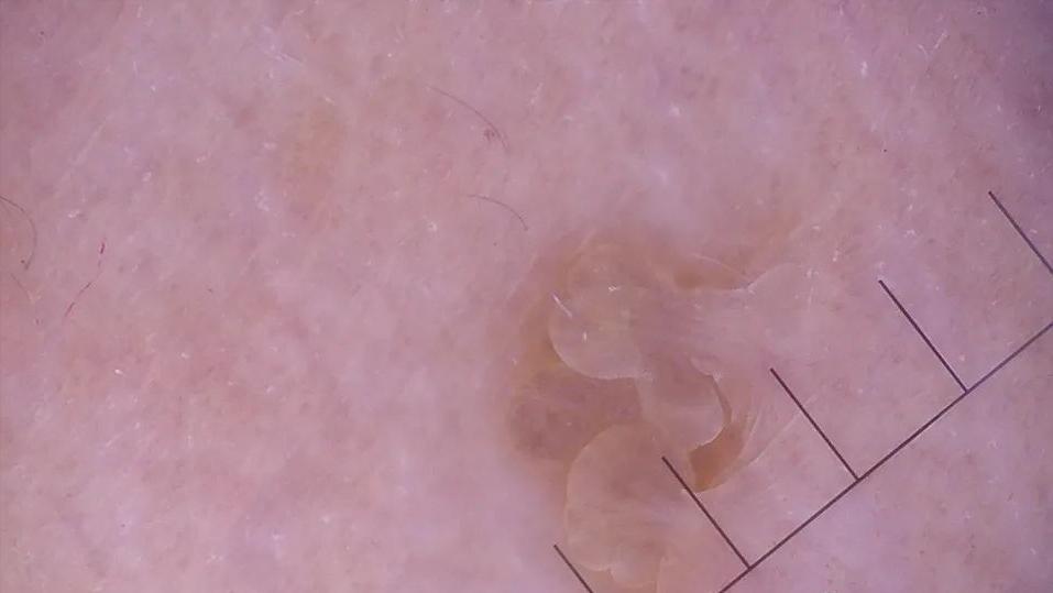 hpv病毒引起的疣是什么,hpv引起的病毒疣