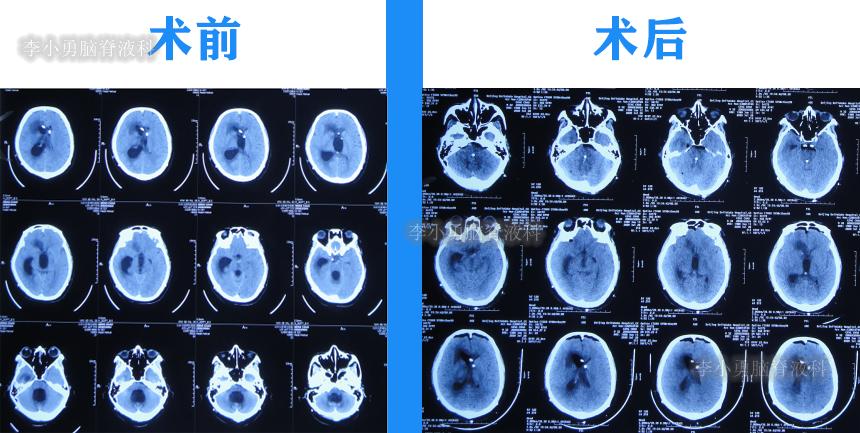 脑积水三脑室造瘘多久能恢复,脑囊虫手术后脑积水