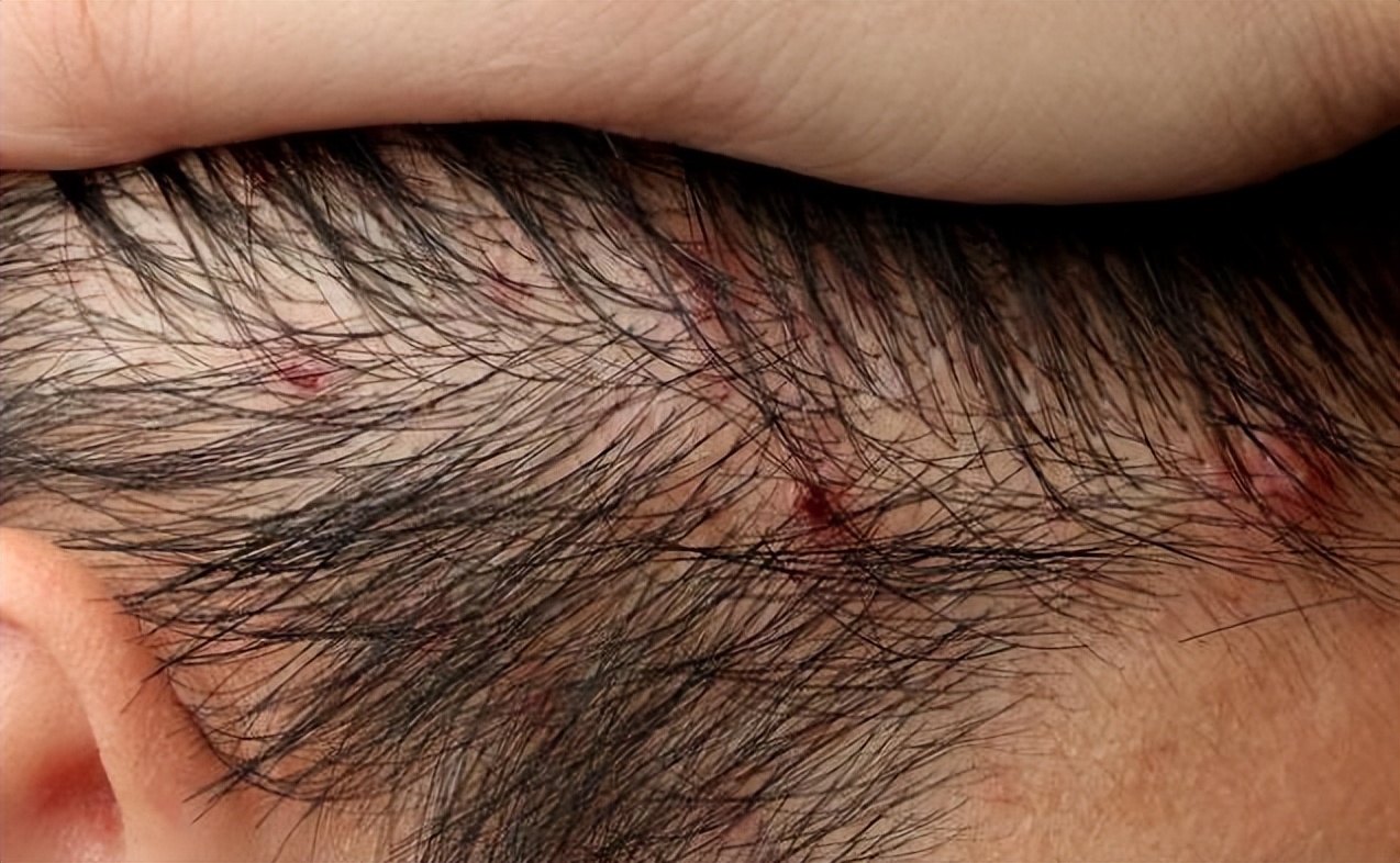 头皮上全是疙瘩大脓包是什么原因,头皮长疙瘩和脓包是怎么回事