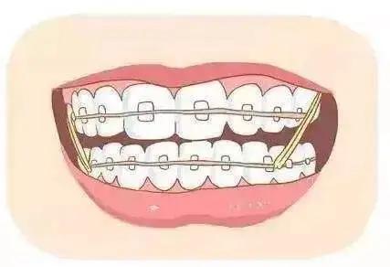 矫正失败还能二次矫正吗,二次矫正牙齿后遗症