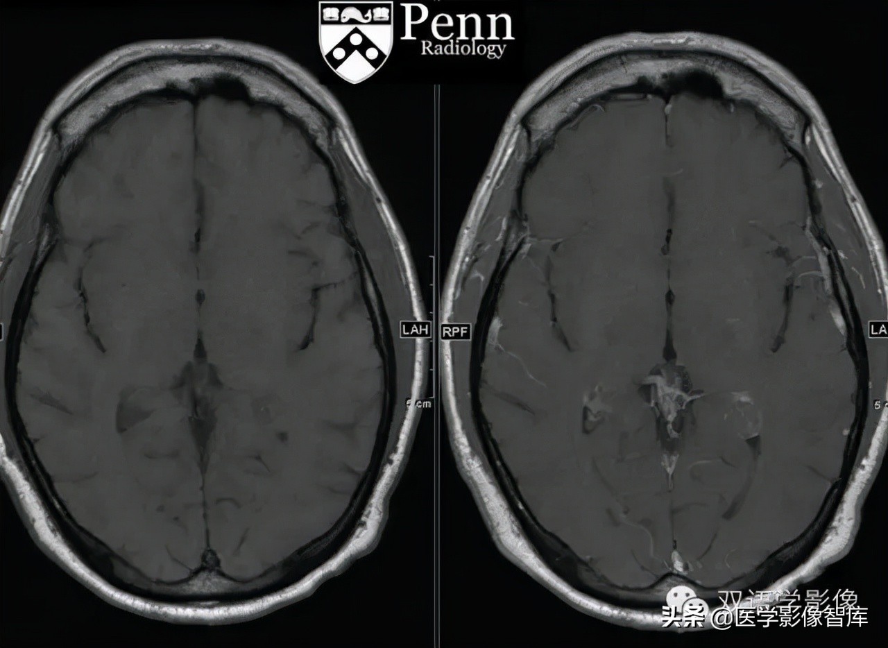 脉络丛黄色肉芽肿的进一步检查,脉络丛黄色肉芽肿有中成药吗