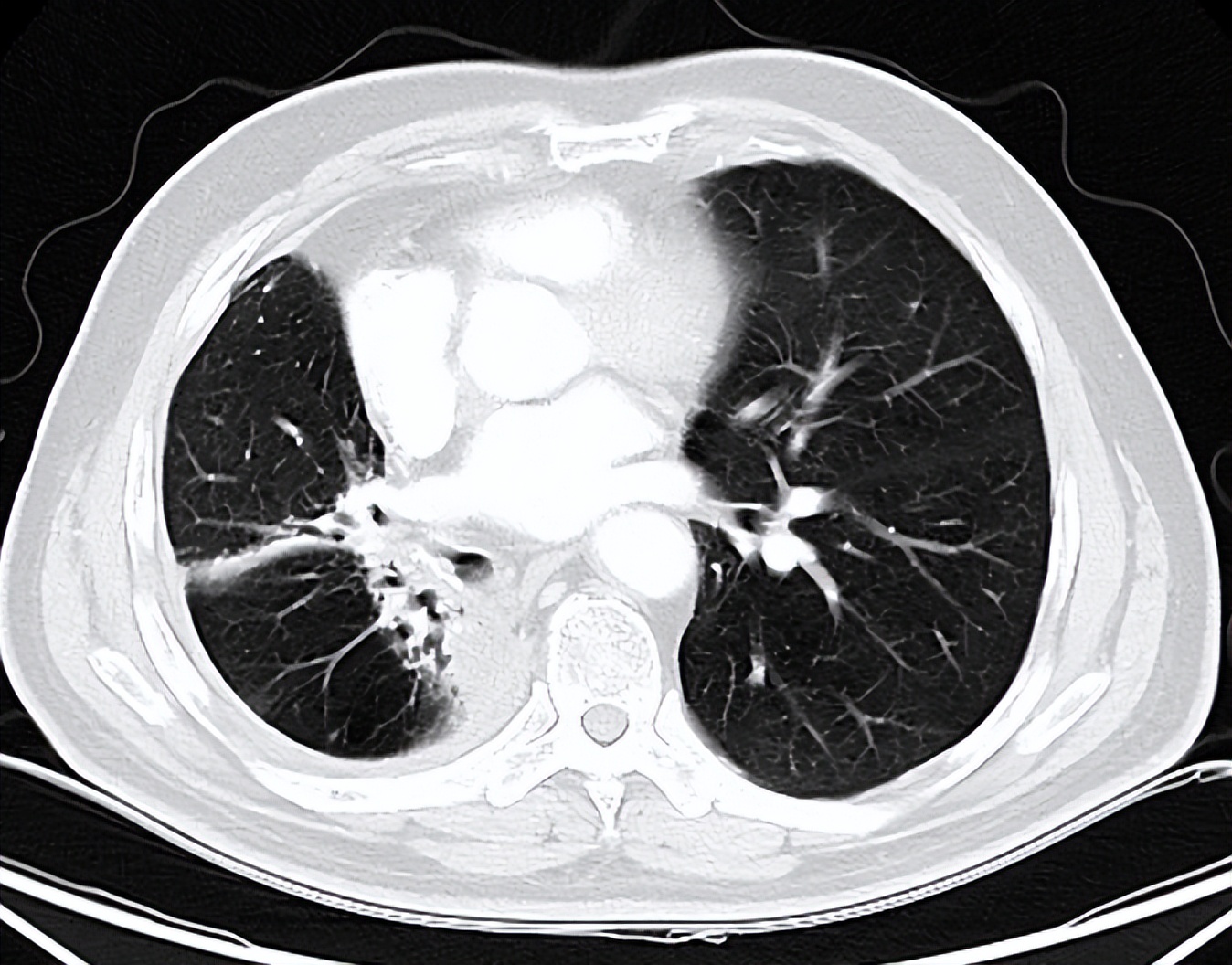 肺癌术后复发胸膜转移,肺癌术后复发转移还需要治疗吗