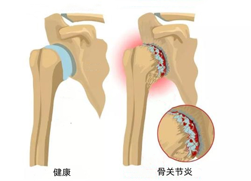 肩膀抬手时咯咯响,肩膀转动吱吱响怎么回事