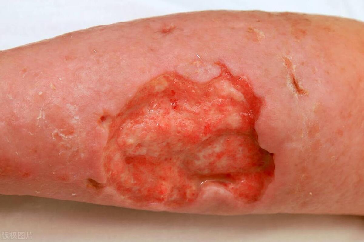 口腔癌症的初期症状和危害,口腔癌症的初期表现症状是什么