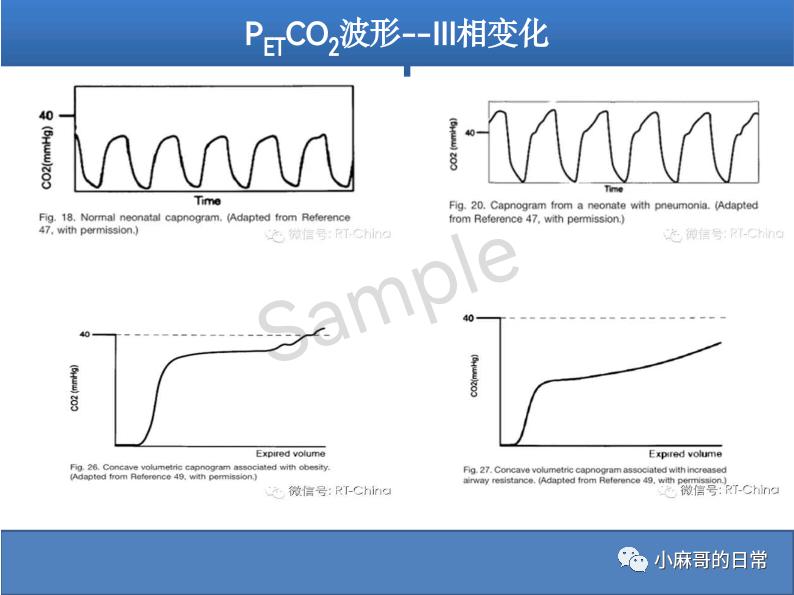 呼气末二氧化碳检测图的解读,呼气末二氧化碳检测操作视频