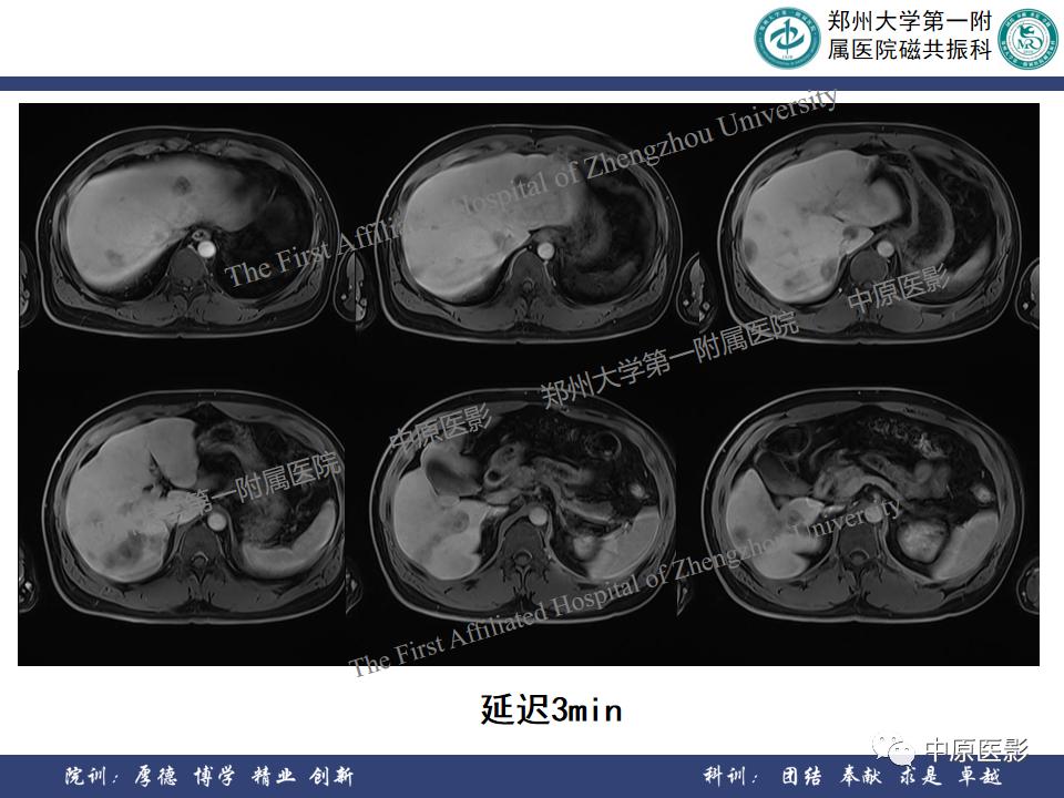 肝脏血管瘤样本,正确认识肝脏血管瘤文章