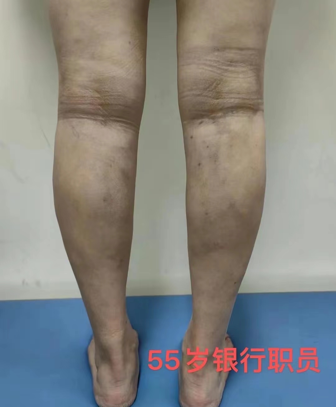 专家讲静脉曲张的治疗方法,静脉曲张临床诊治专家