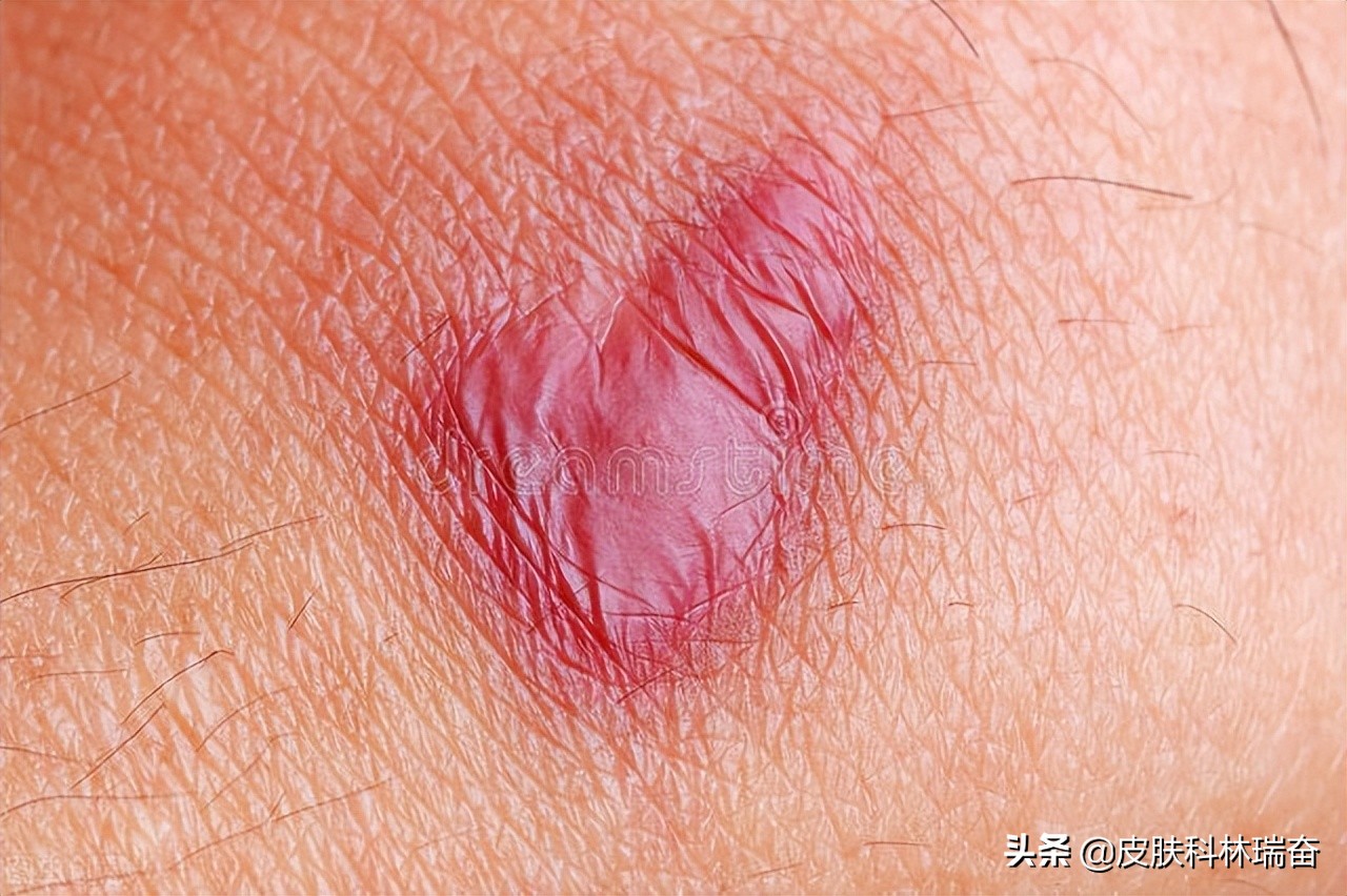 各种疤的修复方法,各种疤痕淡化