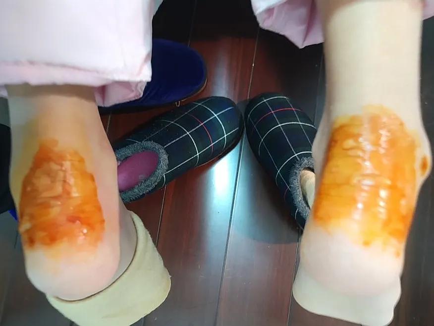 脚后跟红肿起硬皮怎么办,脚后跟红肿怎么处理