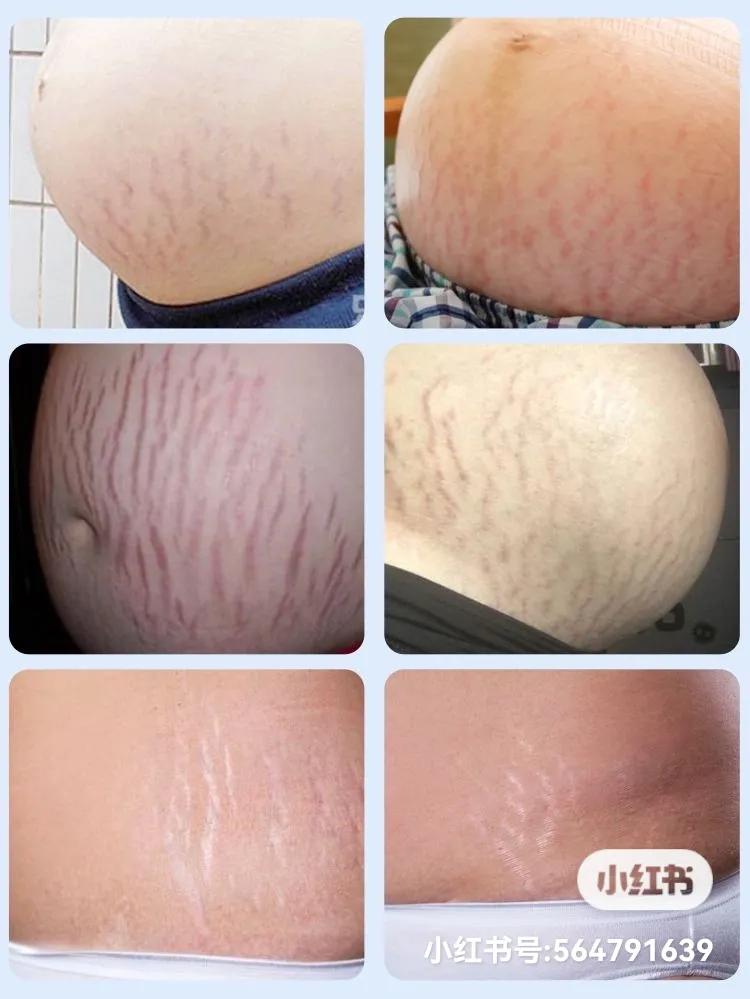 怀孕胸上长妊娠纹可以涂妊娠油么,强生婴儿油可以预防妊娠纹吗