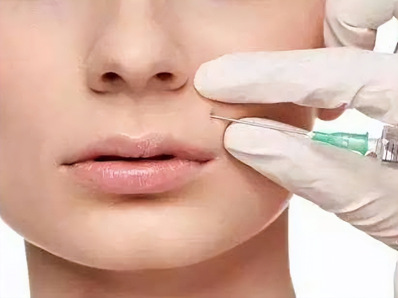 最近法令纹越来越严重是怎么回事,法令纹怎么去除男生不会有副作用