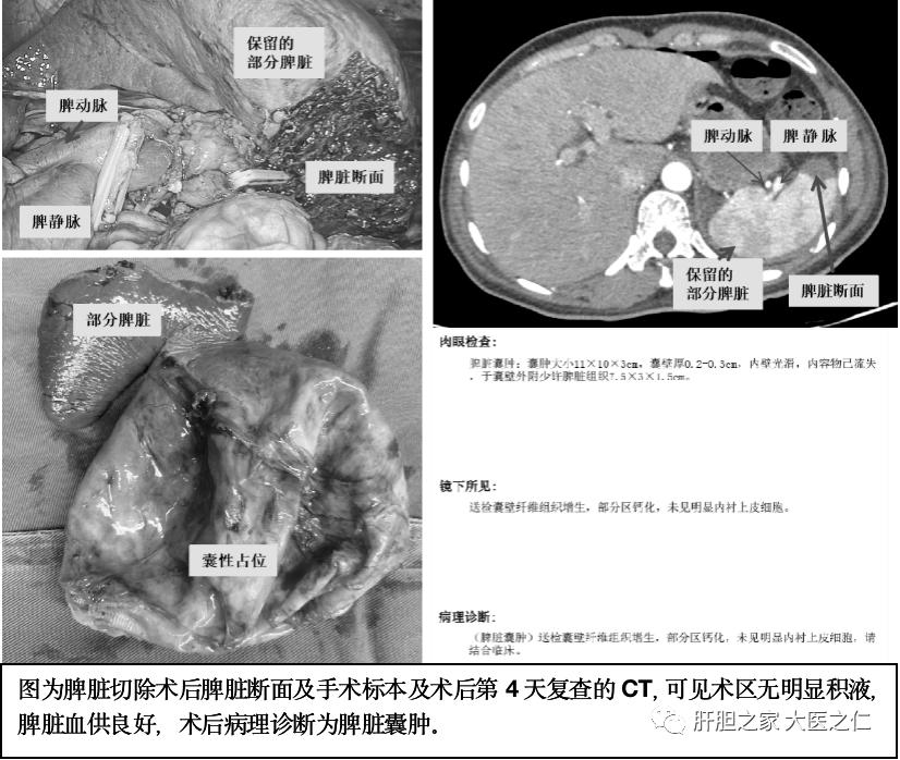 南昌大学二附院肝胆胰外科王恺教授团队为一例“脾脏巨大囊性占位”患者成功实施了腹腔镜下脾脏部分切除手术
