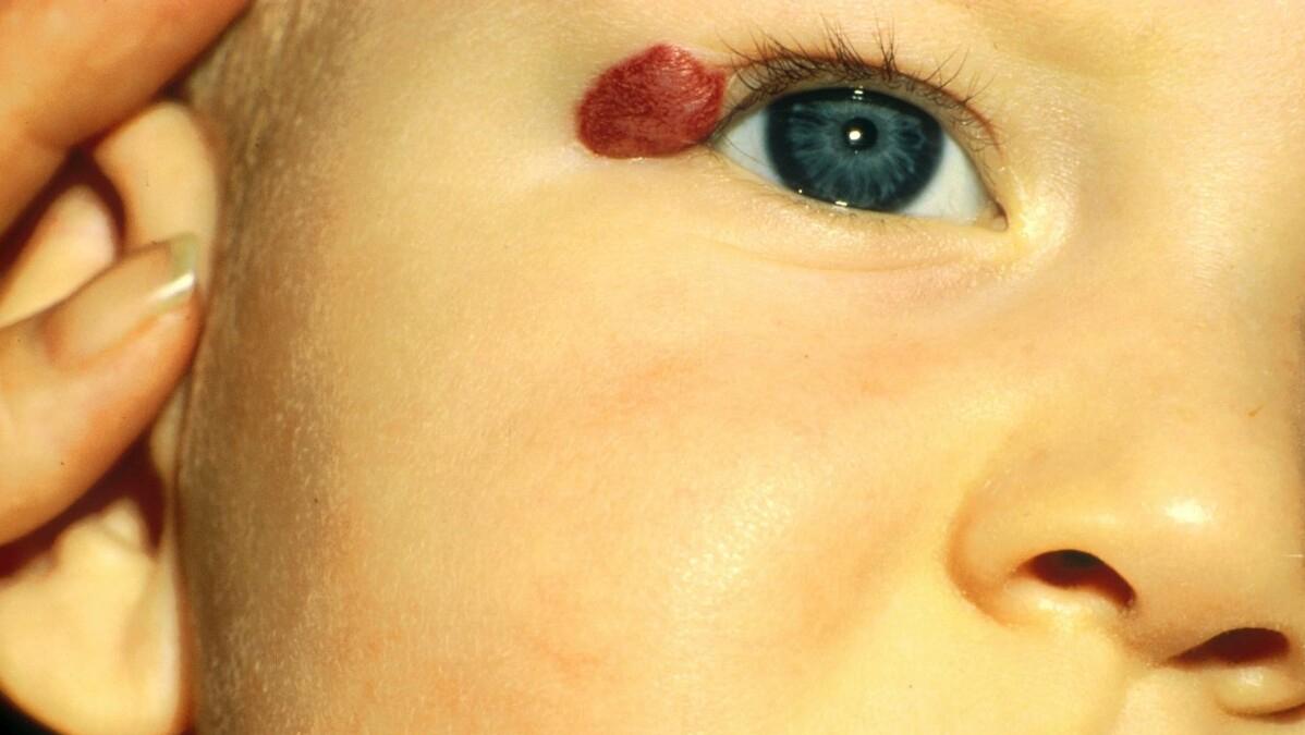 血管瘤要怎么治疗效果才最好,发现血管瘤怎么治疗好