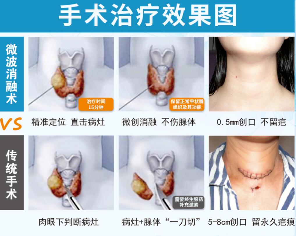 甲状腺结节往下移了可以做消融吗,甲状腺结节恶变了严重吗