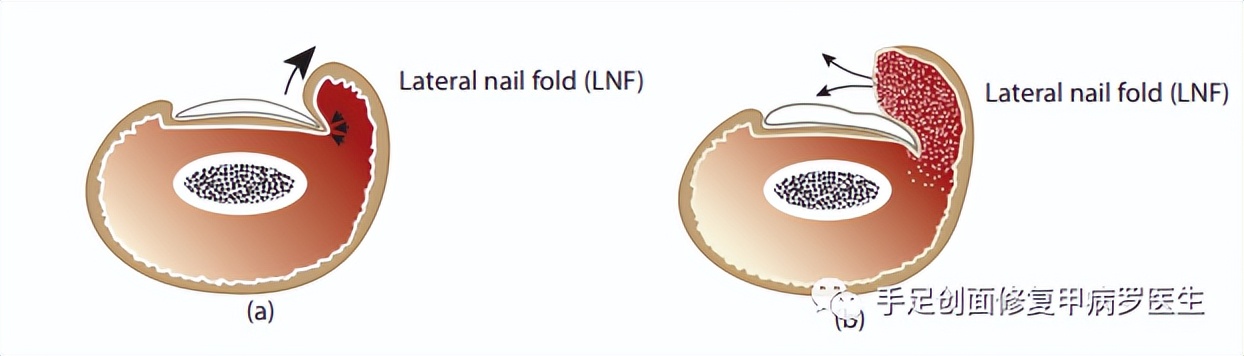 宝宝脚趾甲有脓了怎么处理,给宝宝剪指甲流脓怎么办