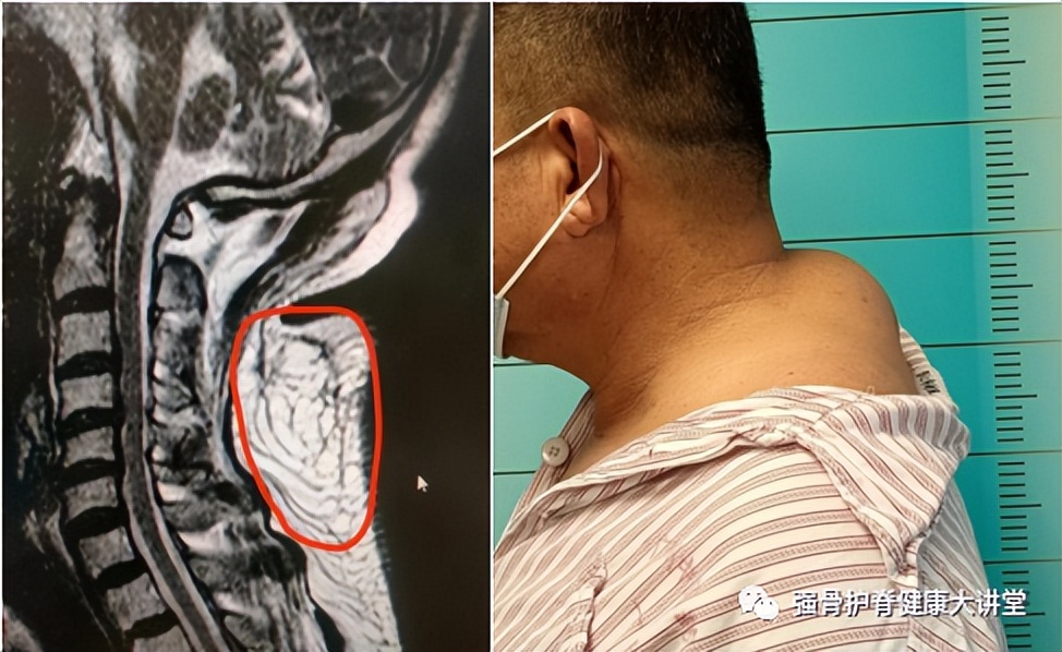 「医学科普」讨嫌的富贵包怎样形成的？怎么治疗？