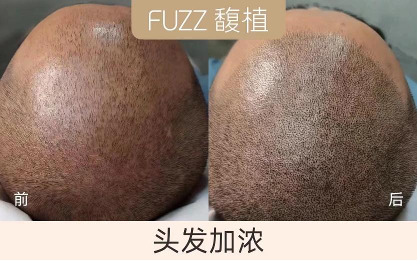 熬夜脱发怎么办最有效,熬夜脱发怎么办最有效的办法