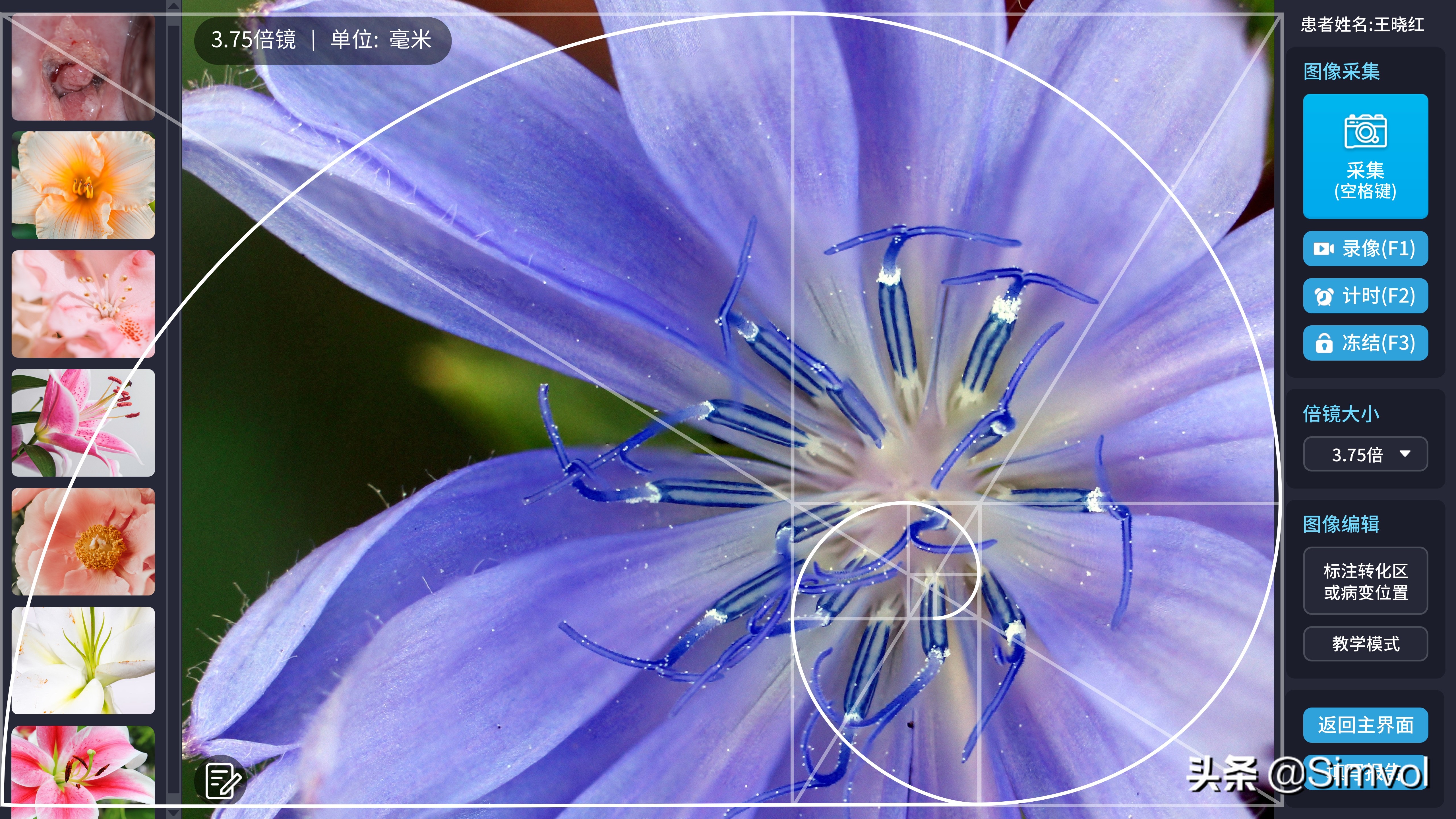 阴道镜的软实力——简源阴道镜软件