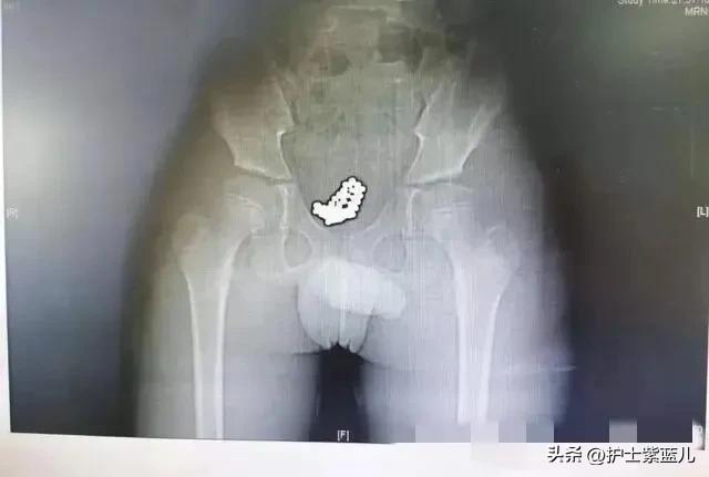 6岁女孩出血怎么回事不疼,6岁女孩出血怎么回事