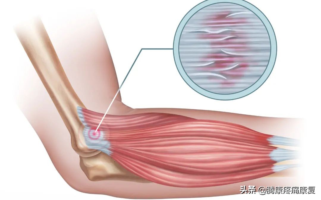 女性左侧软组织疼痛,常见疼痛类型有哪些特点