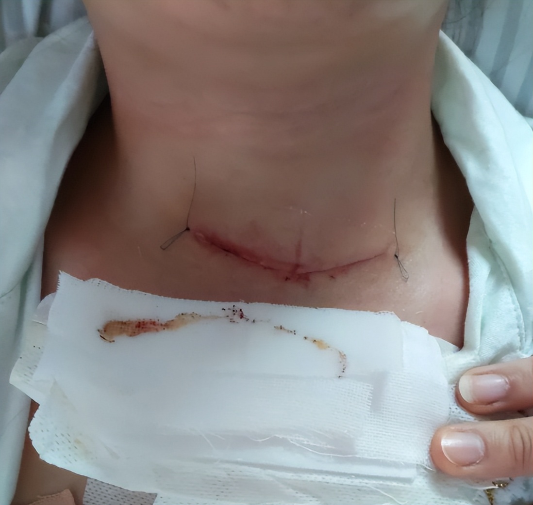 甲状腺癌教师资格证体检能过吗,抗癌日记忠告要体检