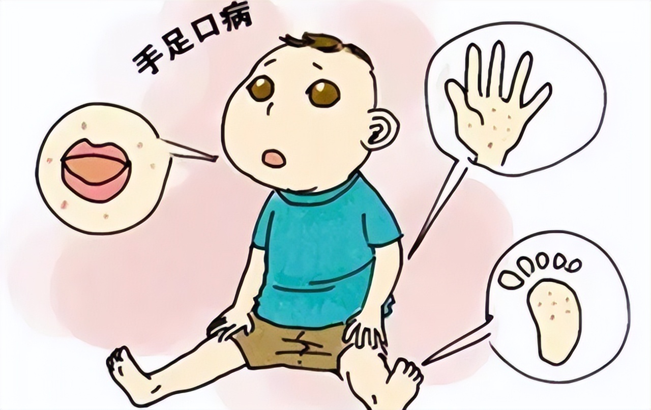 小孩下雨前手心长水泡,淋雨后手上透明水泡