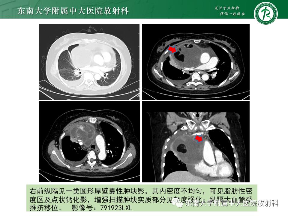 好文分享值得深思,纵隔精原细胞瘤