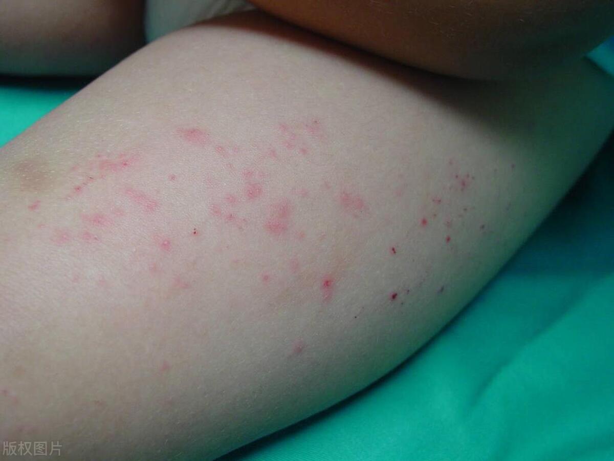 亲戚卧床引发惊恐，媳妇*裤内**惊现红点痒感，就医惊现阴虱真相