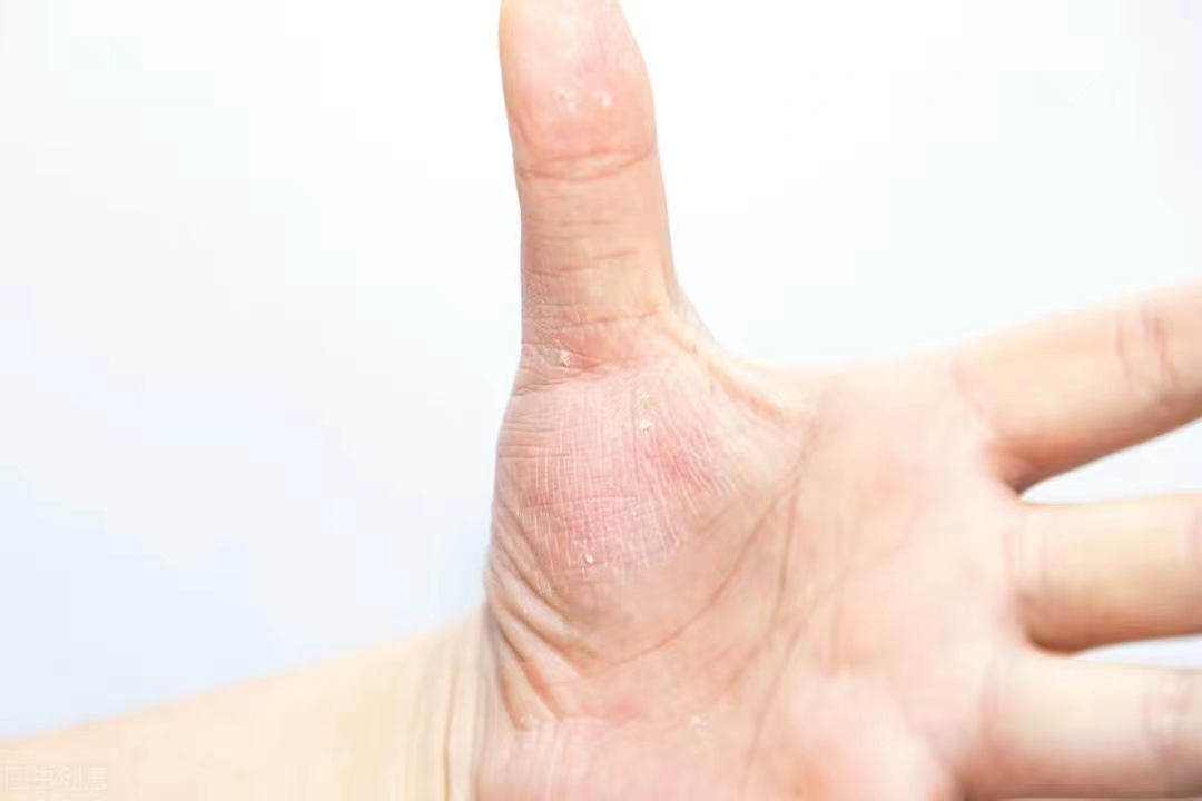 专治湿疹荨麻疹汗疱疹小妙招,从湿疹到荨麻疹到疱疹是严重了吗