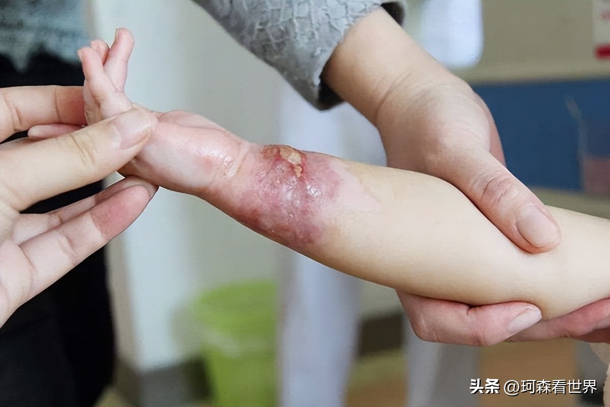 烫伤感染怎么处理,孩子在学校被同学烫伤怎么处理