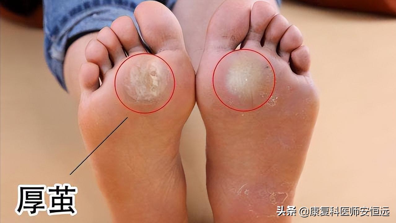 脚底板爱发烫是什么原因,脚底板生茧很疼怎么回事