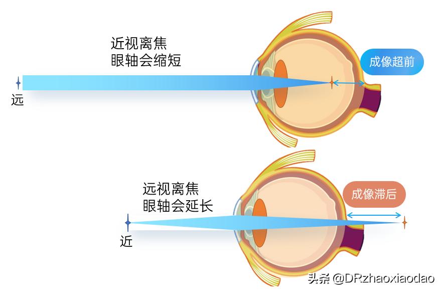 雾视镜防控近视真的有用吗,雾视屏治疗近视眼真的吗