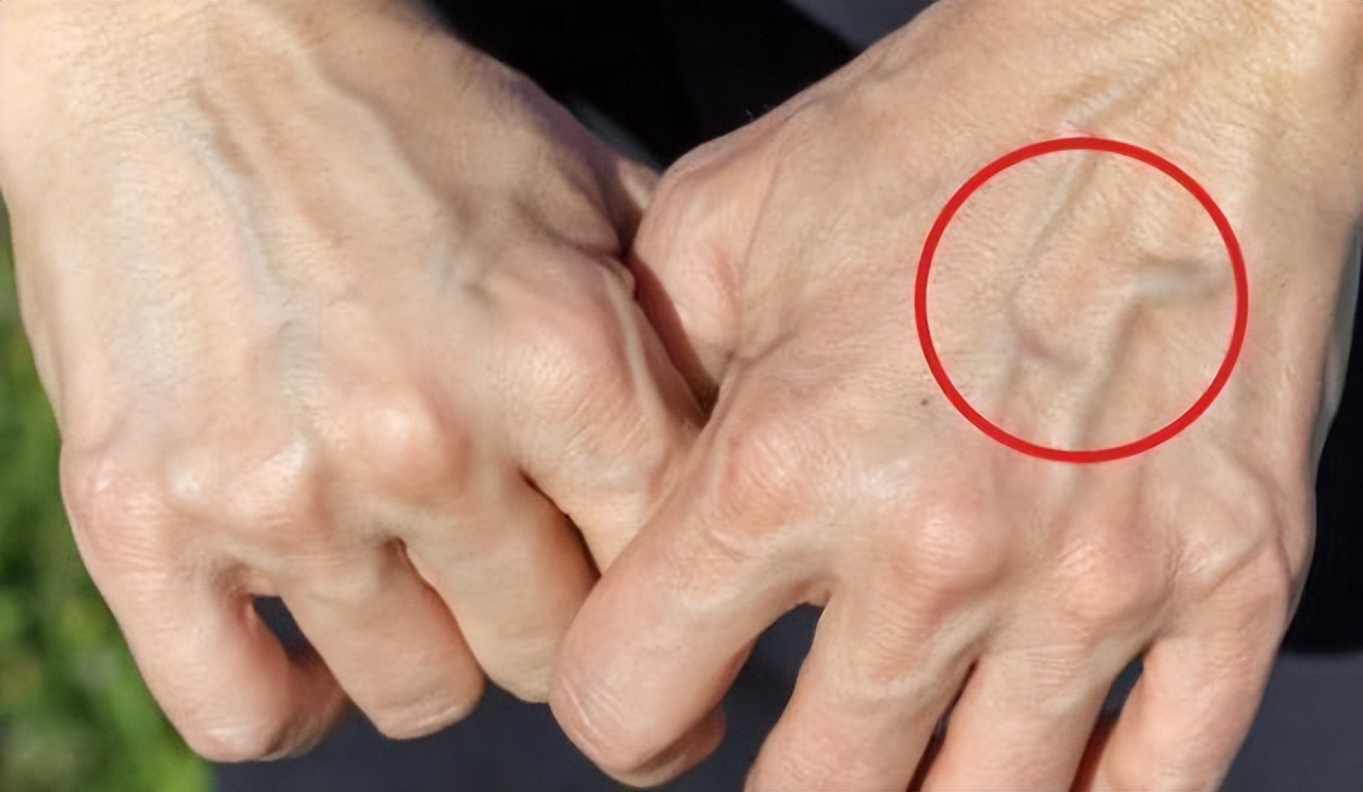 人手臂上的青筋看得出吗,手臂爆青筋是天生的吗