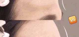 填充额头出现凹坑过于饱满,额头填充怎么避免踩坑