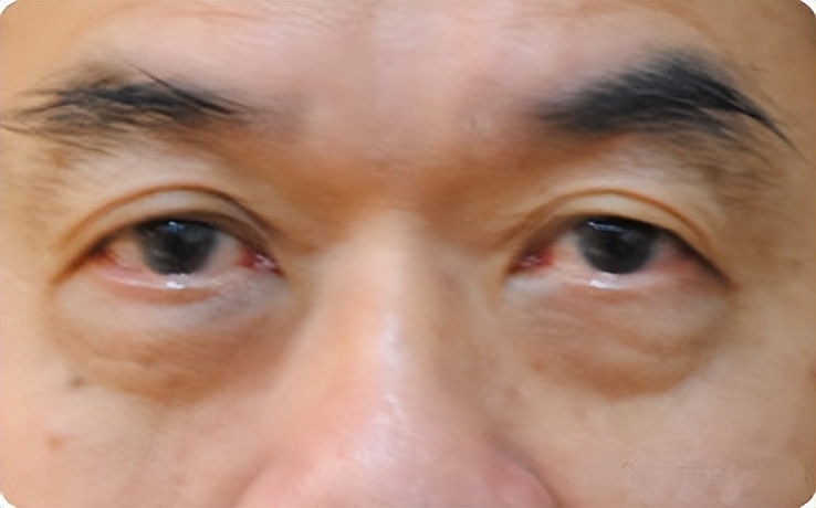 眼袋的10种症状,眼袋的类型包括哪五个