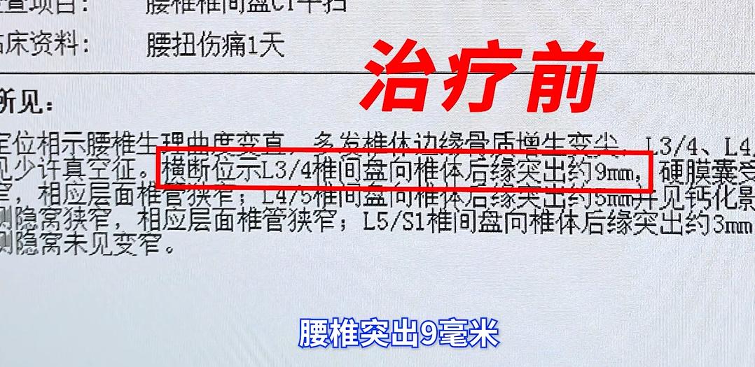 腰椎间盘突出中药保守治疗,腰椎间盘突出理疗和药物治疗的方法