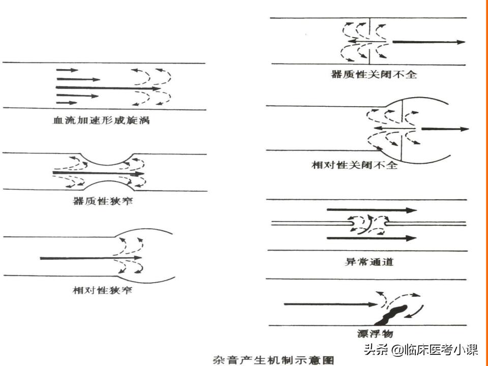 额外心音是心脏杂音吗,心脏第三心音正常吗